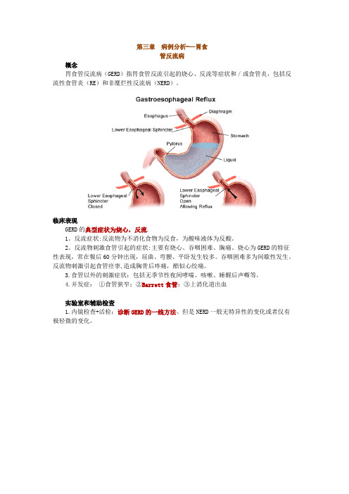 病例分析——胃食管反流病