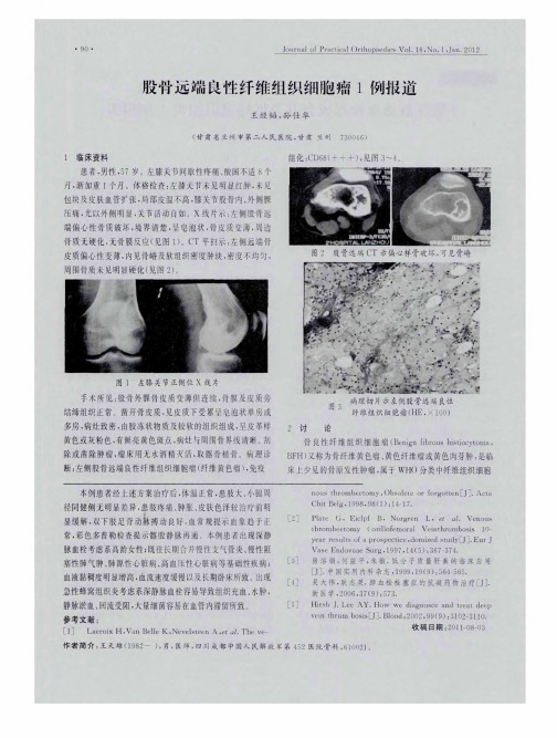股骨远端良性纤维组织细胞瘤1例报道