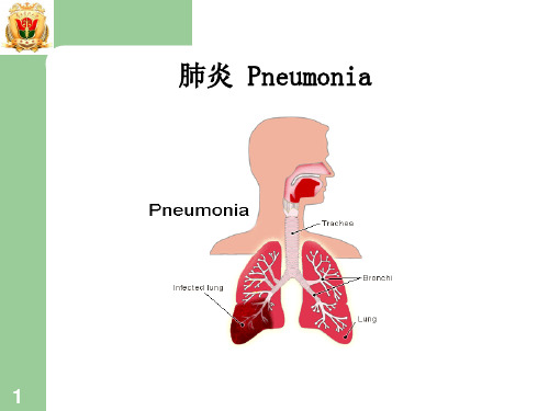 (儿科)肺炎