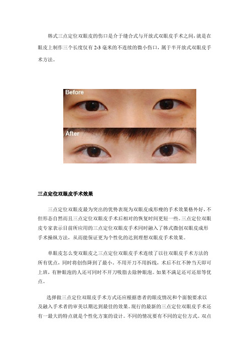 简介三点定位双眼皮