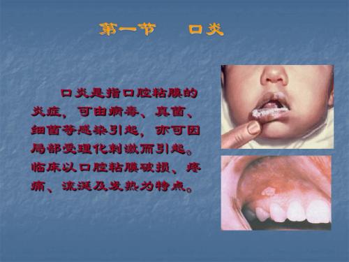 口炎患儿的护理PPT课件