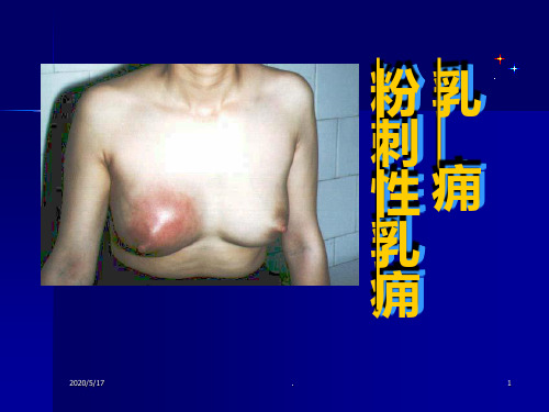 乳痈PPT课件