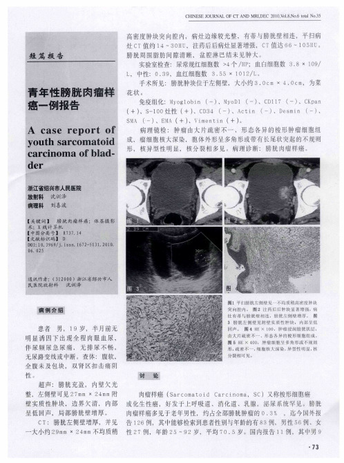 青年性膀胱肉瘤样癌一例报告