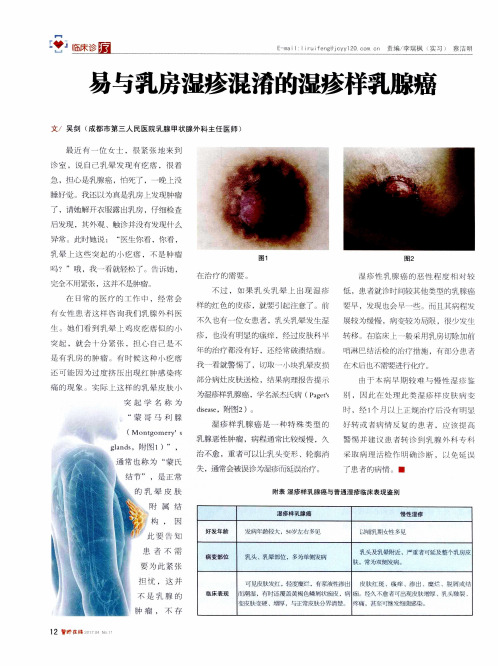 易与乳房湿疹混淆的湿疹样乳腺癌