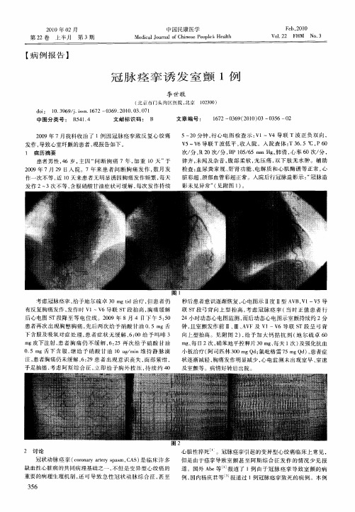 冠脉痉挛诱发室颤1例