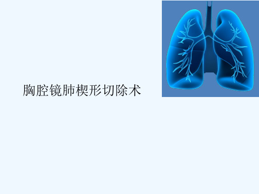 胸腔镜肺楔形切除术课件