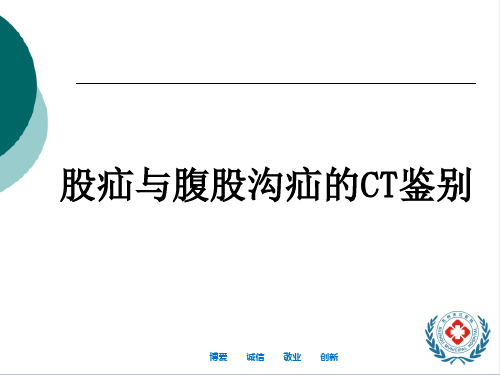 股疝与腹股沟疝的CT鉴别