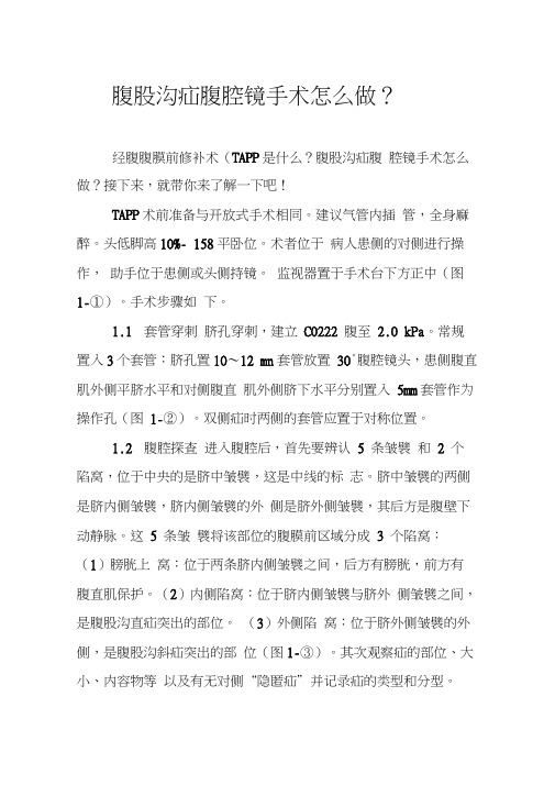 腹股沟疝腹腔镜手术怎么做？