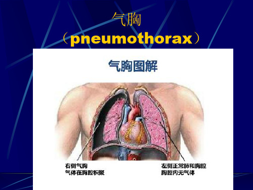 气胸--ppt课件精选全文完整版