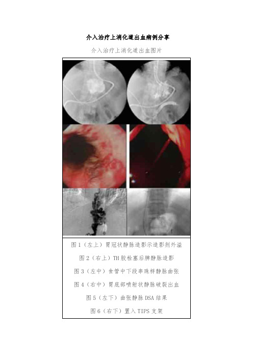 介入治疗上消化道出血病例分享