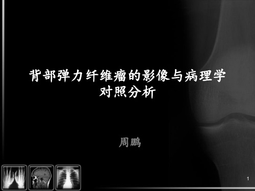 背部弹力纤维瘤的影像与病理学对照分析ppt课件