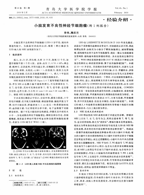 小脑发育不良性神经节细胞瘤(附1例报告)