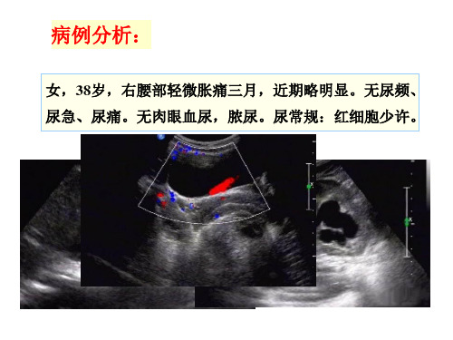 肾脏疾病的超声诊断