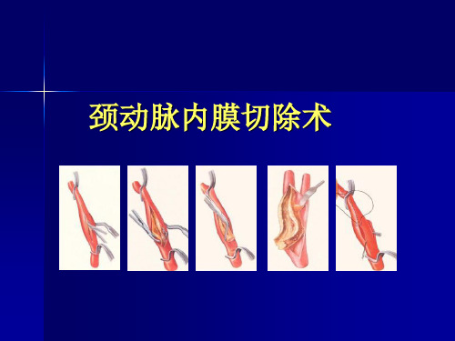 颈内动脉内膜剥脱术