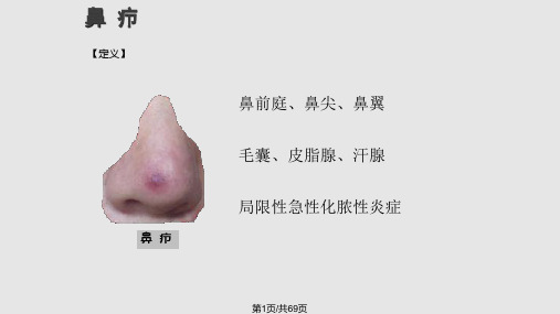 鼻部常见疾病病人的护理PPT课件