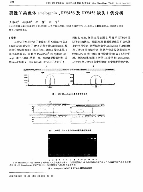 男性Y染色体amelogenin、DYS456及DYS458缺失1例分析