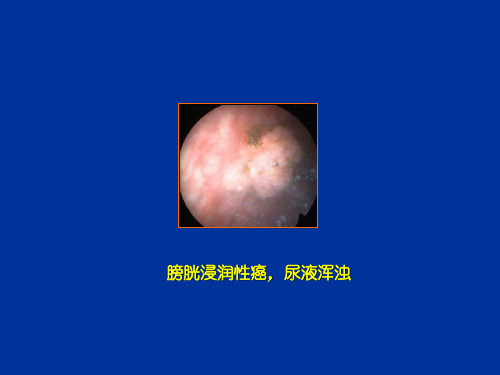 最新 膀胱镜图谱(75页)