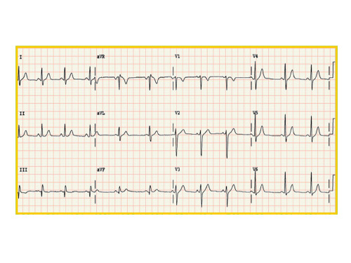 心电图课件PPT课件