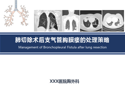 肺切除术后支气管胸膜瘘的处理策略