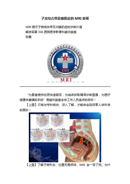 子宫结合带及腺肌症的MRI表现
