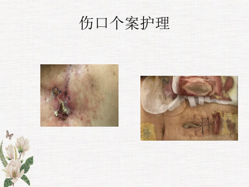 伤口个案护理
