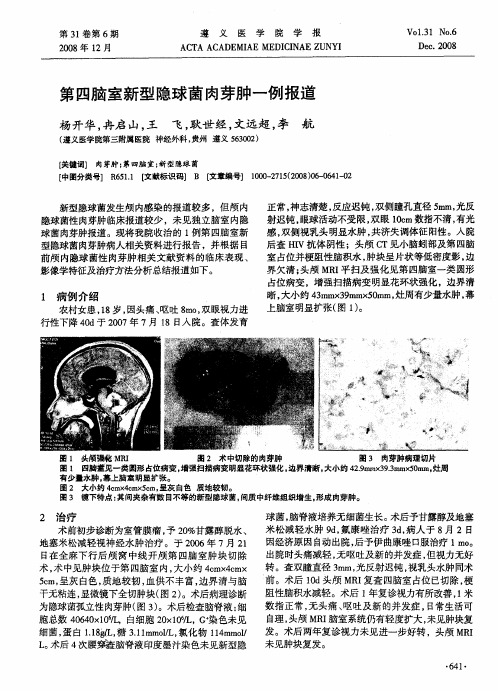 第四脑室新型隐球菌肉芽肿一例报道