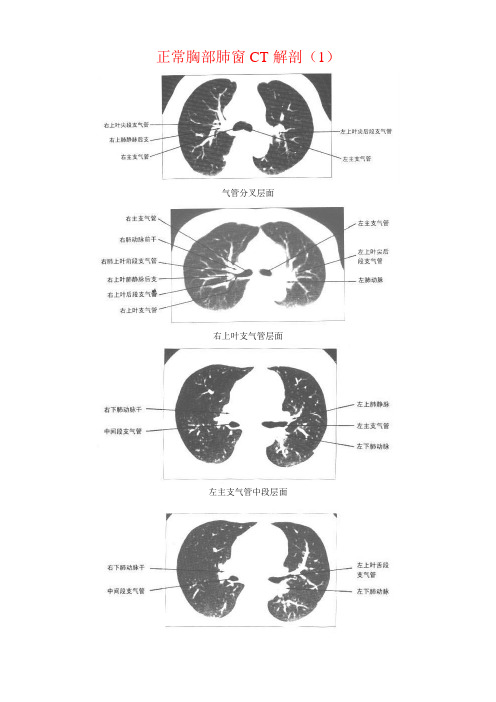 正常胸部CT解剖(肺窗和纵隔窗)