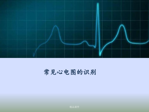 常见心电图识别