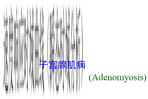 子宫腺肌病教学查房PPT