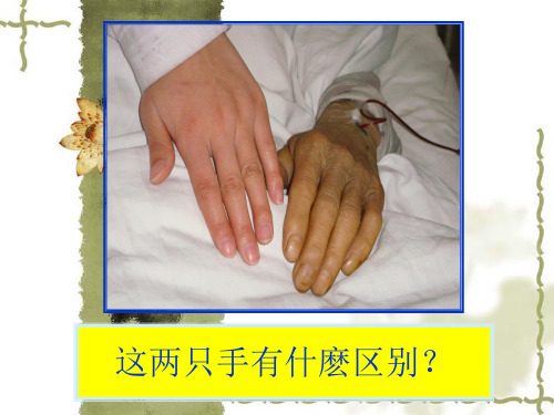 黄疸