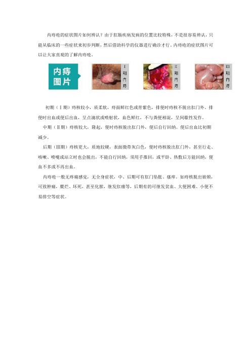 内痔疮的症状图片如何辨认