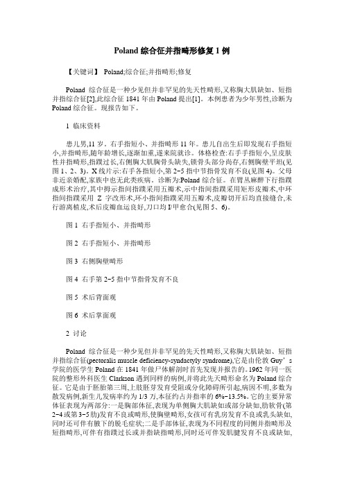Poland综合征并指畸形修复1例