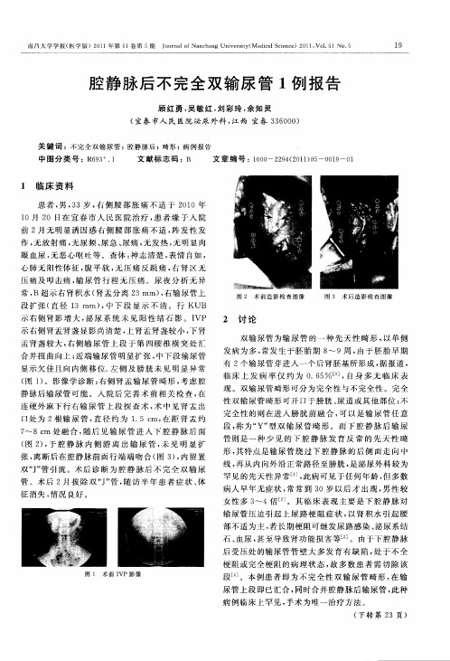 腔静脉后不完全双输尿管1例报告