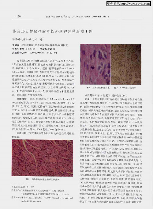 伴菊形团样结构的恶性外周神经鞘膜瘤1例