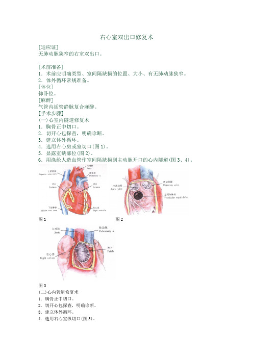 右心室双出口修复术