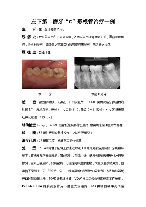 左下第二磨牙C形根管治疗一例