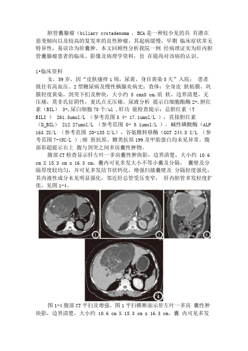 肝内胆管囊腺瘤CT与MRI表现及鉴别