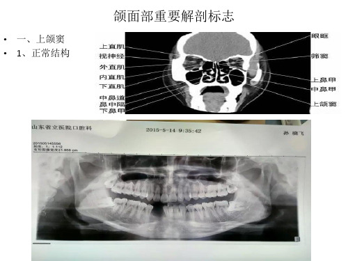 颌面部重要解剖标志