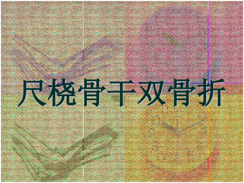 尺桡骨干双骨折 (3)