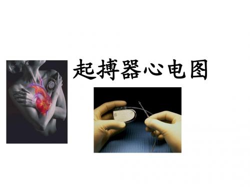起搏器基础知识课件