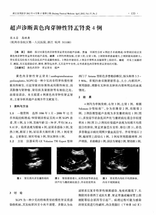 超声诊断黄色肉芽肿性肾盂肾炎4例