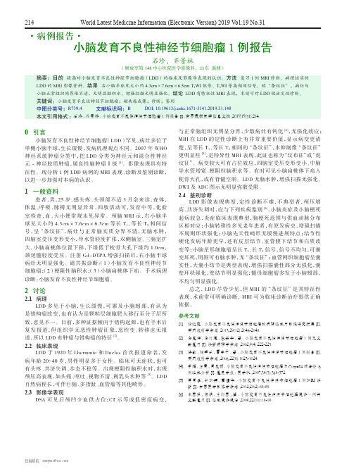 小脑发育不良性神经节细胞瘤1例报告