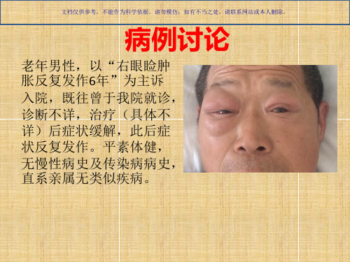 眼眶炎性假瘤课件