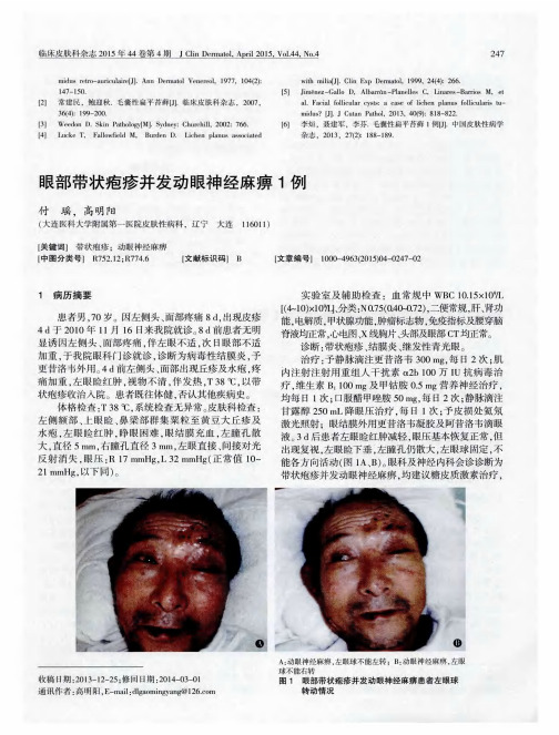 眼部带状疱疹并发动眼神经麻痹1例