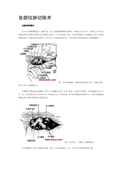 各部位肺切除术