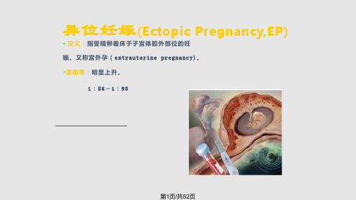 妇产异位妊娠PPT课件