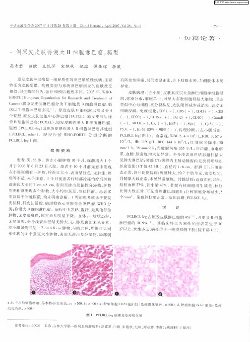 一例原发皮肤弥漫大B细胞淋巴瘤,腿型