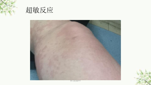 变态反应性疾病课件