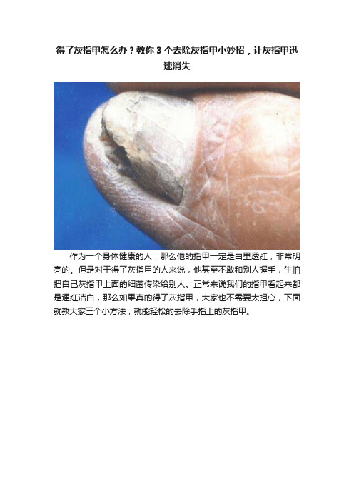 得了灰指甲怎么办？教你3个去除灰指甲小妙招，让灰指甲迅速消失