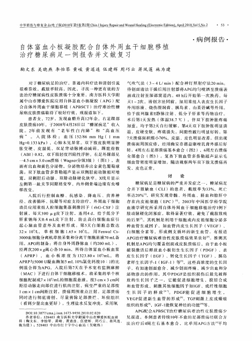 自体富血小板凝胶配合自体外周血干细胞移植治疗糖尿病足一例报告并文献复习
